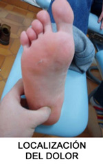 Fascitis plantar