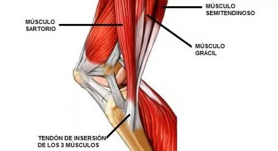 Tendinitis pata de ganso